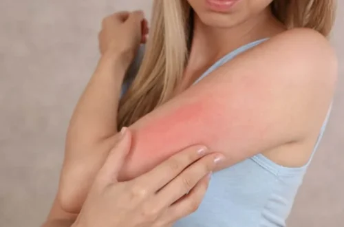 Eczedone: An In-Depth Look at This All-Natural Eczema Remedy
