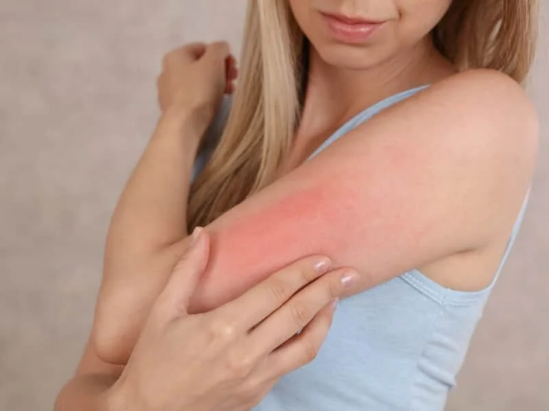 Eczedone: An In-Depth Look at This All-Natural Eczema Remedy