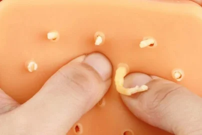 New Pimple Popping Videos