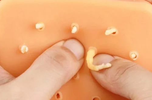 New Pimple Popping Videos