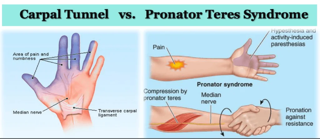 Two Conditions That are Often Misdiagnosed as Carpal Tunnel Syndrome