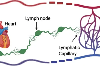 Lymfedeema: Causes, Symptoms, Treatment, and Living Well