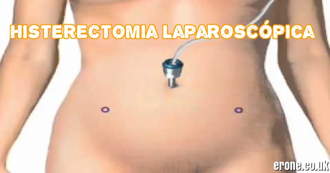 Histerectomia Laparoscópica