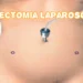 Histerectomia Laparoscópica